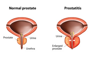 Normal prostate and acute prostatitis. medical illustration
