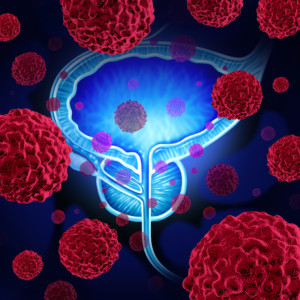 prostate malignant tumor growth