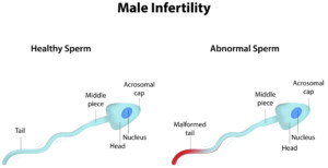 Male infertility, how to increase sperm count