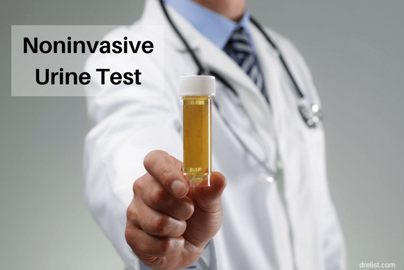 Bladder Cancer : Noninvasive Urine Test
