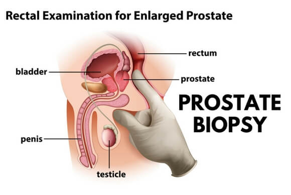 Are There Alternatives to Prostate Biopsy?
