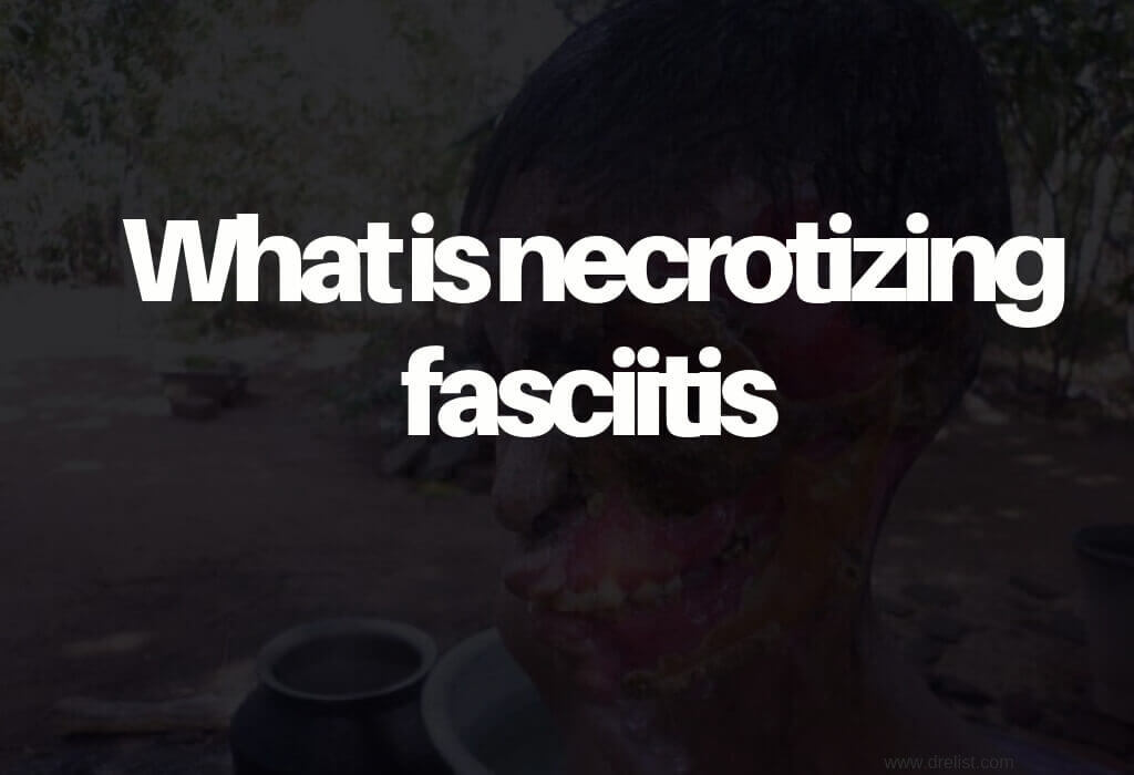 What is necrotizing fasciitis