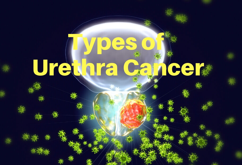 Types of Urethral Cancer