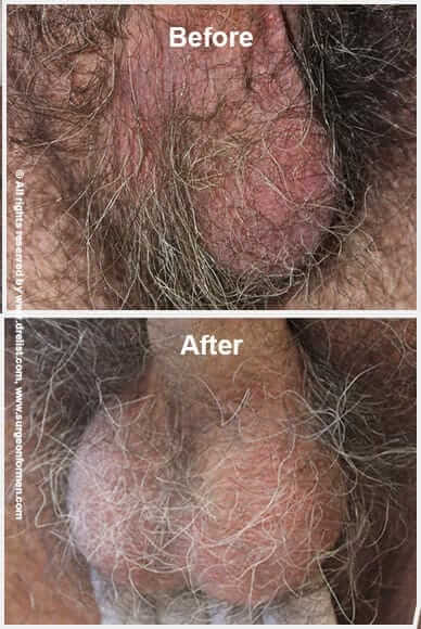 Before & After Scrotal Enhancement 