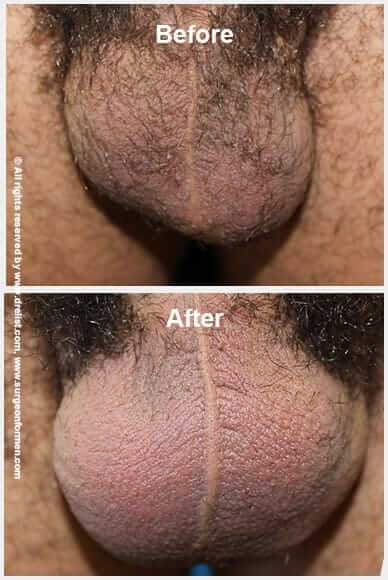 Before & After Scrotal Enhancement 