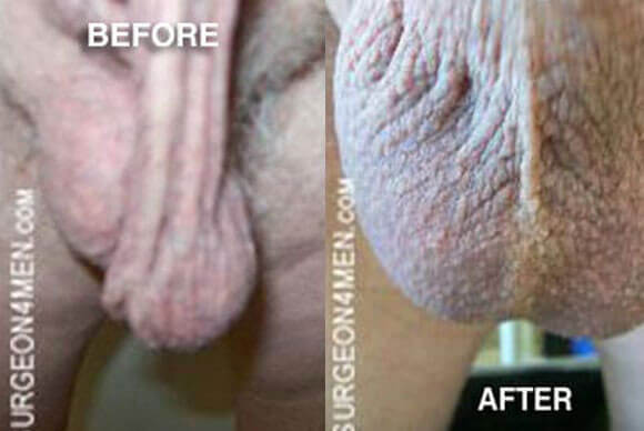 Before & After Scrotal Enhancement 