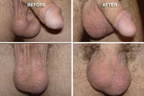Before & After Scrotal Enhancement 