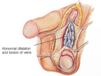 Varicocele Repair Surgery