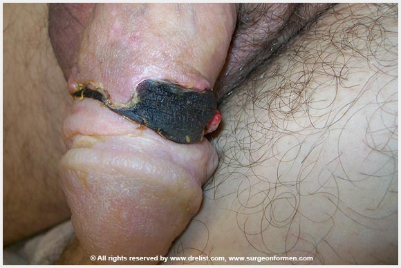 Random Alloderm Cases
