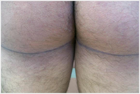 Dermal Graft Aka Dermal Fat Grafts Come From