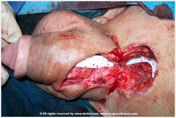 CASE #1: (DFG) Severe Infection, Removal, And Penis Reconstruction Surgery