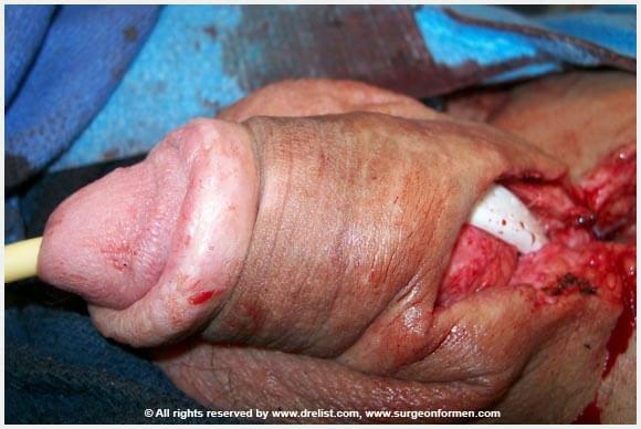 CASE #1: (DFG) Severe Infection, Removal, And Penis Reconstruction Surgery