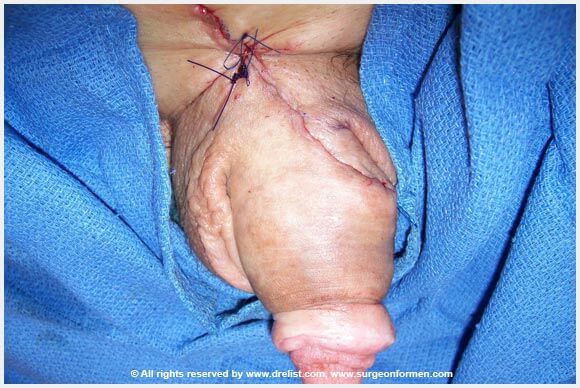 CASE #1: (DFG) Severe Infection, Removal, And Penis Reconstruction Surgery