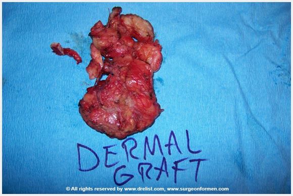 CASE #2: (DFG) Severe Infection, Removal, and Penis Reconstruction Surgery