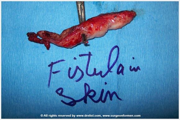 CASE #2: (DFG) Severe Infection, Removal, and Penis Reconstruction Surgery