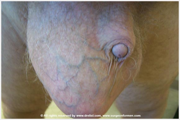 Patient With Scrotum PMMA Injections