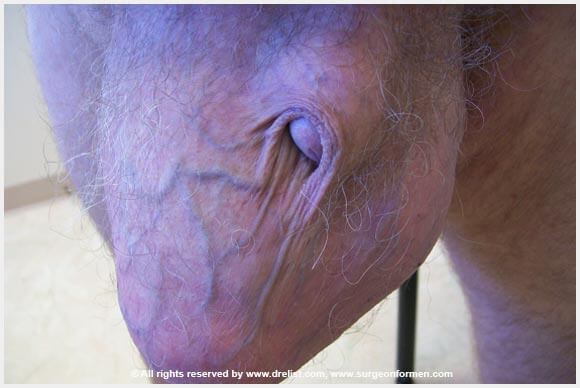 Patient With Scrotum PMMA Injections
