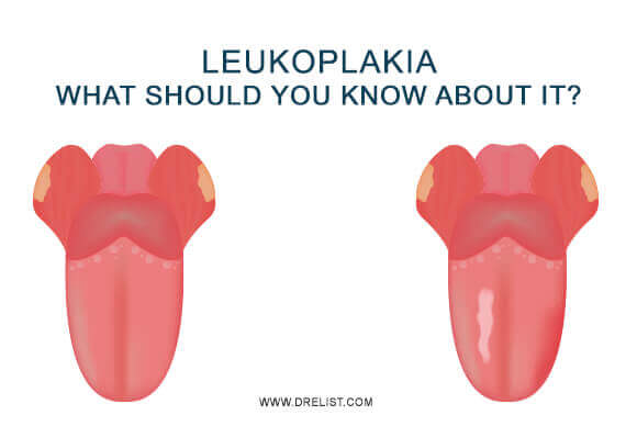 Leukoplakia – What Should You Know About It?