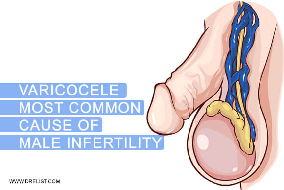 Varicocele –Most Common Cause Of Male Infertility