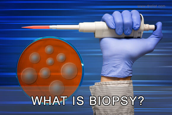 What Is Biopsy?