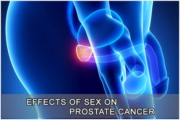 Effects of Sex on Prostate Cancer