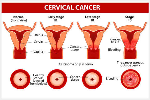 HPV Vaccine and Cervical Cancer