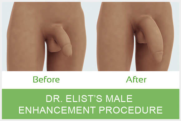Dr. Elist Himplant Reviews in the news